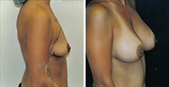 Breast Augmentation Patient Before & After Photo 1