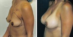 Breast Augmentation Patient Before & After Photo 1