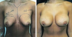 Breast Augmentation Patient Before & After Photo 1