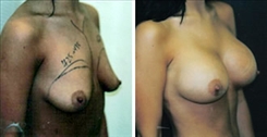 Breast Augmentation Patient Before & After Photo 1