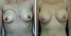 Breast Augmentation Patient Before & After Photo 1