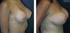 Breast Augmentation Patient Before & After Photo 1