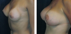 Breast Augmentation Patient Before & After Photo 1