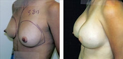 Breast Augmentation Patient Before & After Photo 1