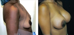 Breast Augmentation Patient Before & After Photo 1