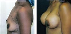 Breast Augmentation Patient Before & After Photo 1