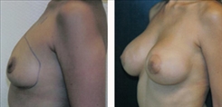 Breast Augmentation Patient Before & After Photo 1