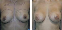 Breast Augmentation Patient Before & After Photo 1