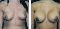 Breast Augmentation Patient Before & After Photo 1