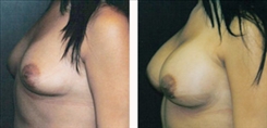 Breast Augmentation Patient Before & After Photo 1