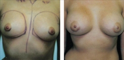 Breast Augmentation Patient Before & After Photo 1