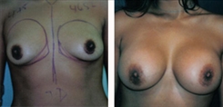 Breast Augmentation Patient Before & After Photo 1