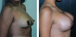 Breast Augmentation Patient Before & After Photo 1