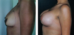 Breast Augmentation Patient Before & After Photo 1