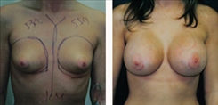 Breast Augmentation Patient Before & After Photo 1