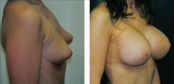 Breast Augmentation Patient Before & After Photo 1