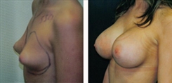 Breast Augmentation Patient Before & After Photo 1