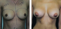 Breast Augmentation Patient Before & After Photo 1