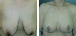 Breast Augmentation Patient Before & After Photo 1