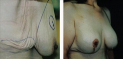 Breast Augmentation Patient Before & After Photo 1