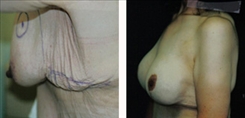 Breast Augmentation Patient Before & After Photo 1