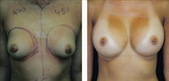 Breast Augmentation Patient Before & After Photo 1