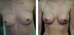 Breast Augmentation Patient Before & After Photo 1