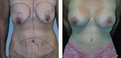 Breast Augmentation Patient Before & After Photo 1