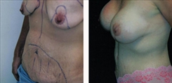 Breast Augmentation Patient Before & After Photo 1