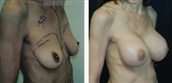 Breast Augmentation Patient Before & After Photo 1