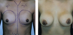 Breast Augmentation Patient Before & After Photo 1