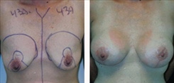 Breast Augmentation Patient Before & After Photo 1