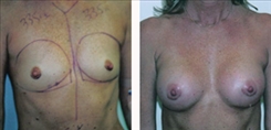 Breast Augmentation Patient Before & After Photo 1