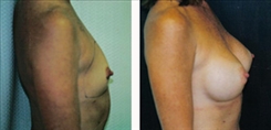 Breast Augmentation Patient Before & After Photo 1