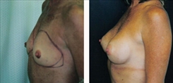 Breast Augmentation Patient Before & After Photo 1