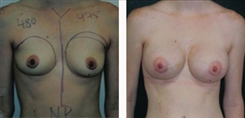 Breast Augmentation Patient Before & After Photo 1