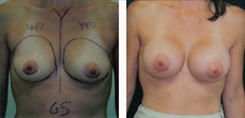 Breast Augmentation Patient Before & After Photo 1