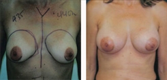 Breast Augmentation Patient Before & After Photo 1