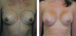 Breast Augmentation Patient Before & After Photo 1