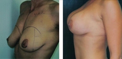 Breast Augmentation Patient Before & After Photo 1