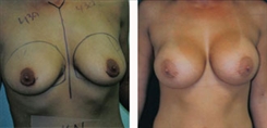 Breast Augmentation Patient Before & After Photo 1