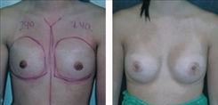 Breast Augmentation Patient Before & After Photo 1