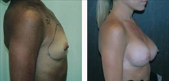 Breast Augmentation Patient Before & After Photo 1