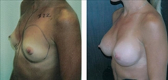 Breast Augmentation Patient Before & After Photo 1