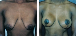 Breast Augmentation Patient Before & After Photo 1