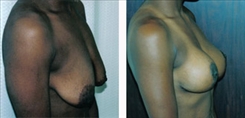 Breast Augmentation Patient Before & After Photo 1