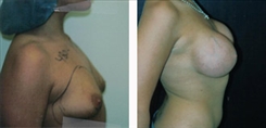 Breast Augmentation Patient Before & After Photo 1