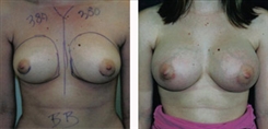 Breast Augmentation Patient Before & After Photo 1