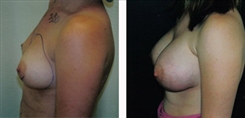 Breast Augmentation Patient Before & After Photo 1