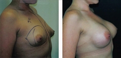 Breast Augmentation Patient Before & After Photo 1